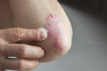 Los problemas gastrointestinales de la psoriasis se deben a una inflamación invisible del intestino