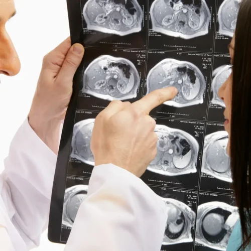 El cáncer olvidado que aumenta entre los jóvenes y desconcierta a los expertos