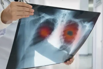 El motivo por el que cada vez hay más casos de cáncer de pulmón en personas que nunca han fumado, según los oncólogos