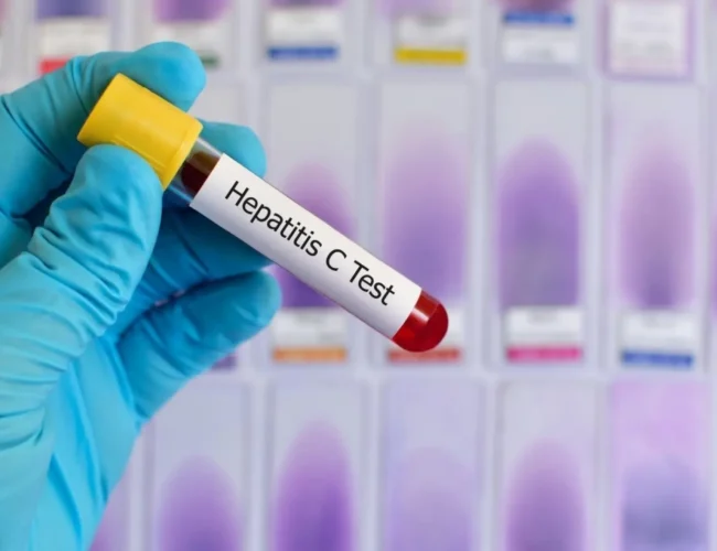 España, a falta de un impulso final para ser el primer país en eliminar la hepatitis C