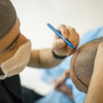 Muere un hombre tras realizarse un trasplante capilar: estos son los riesgos y efectos secundarios más comunes