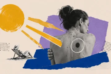 El sol le hace daño a tu piel: este es el riesgo de melanoma, el cáncer de piel más agresivo