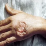Probado con éxito en ratones un nuevo tratamiento para la leishmaniosis cutánea